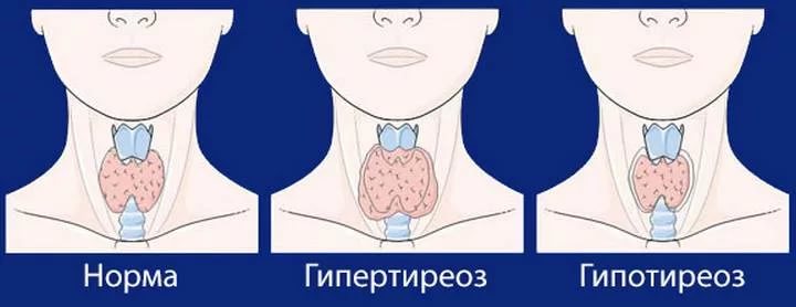 Лечение щитовидки гомеопатией